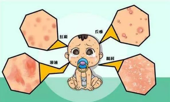 宝宝过敏体质怎么判断严重程度,宝宝过敏体质怎么判断