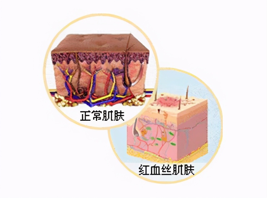 肌肤敏感泛红用什么水乳,肌肤敏感泛红用什么护肤品