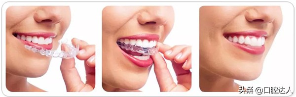 牙齿矫正的步骤,牙齿矫正怎么操作的