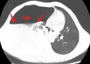 男子打个喷嚏肺泡竟然破了,小伙打个喷嚏