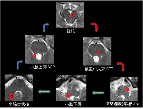 脑出血几年以后复发,脑出血几年后偏瘫越来越严重