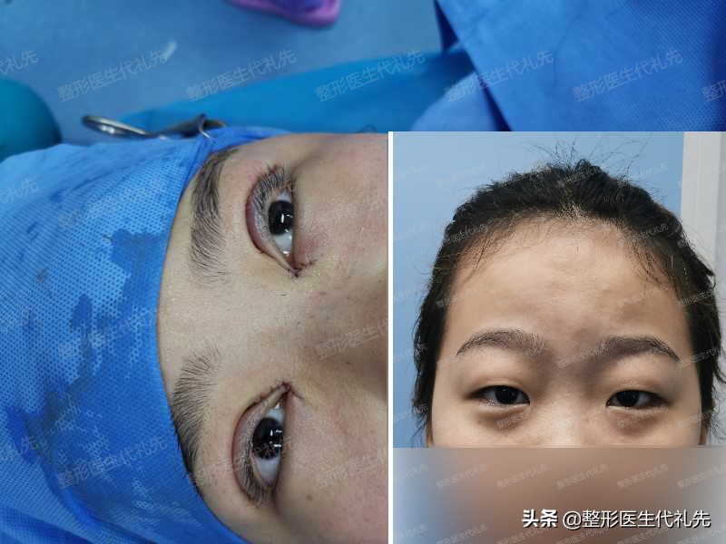 眼睑松弛下垂最佳解决方法,上眼皮松弛显老视频