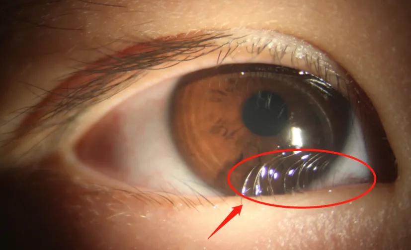 广东5岁男童经常莫名流泪，一查发现眼睑内翻、倒睫，要手术