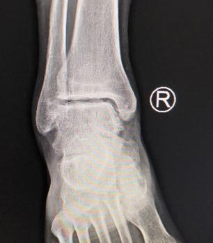 脚踝关节炎痛的站不起来怎么办,脚踝关节炎能不能治疗好