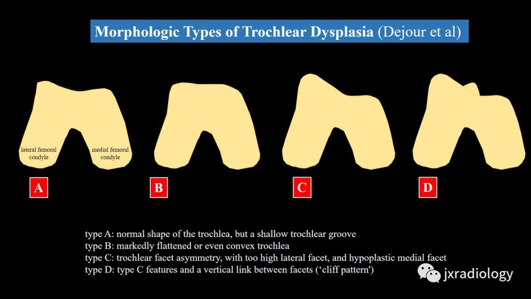 髌股关节失常磁共振看什么,髌股关节混乱的影像评估