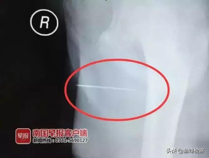 10岁男孩被缝6针,男童体内被插入绣花针险些丧命