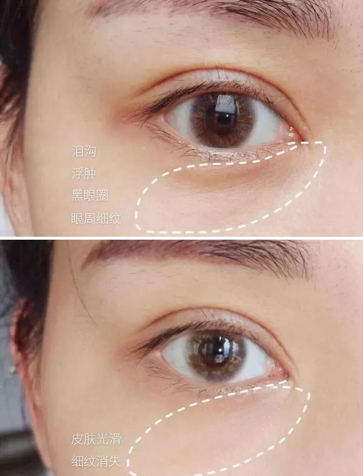 脂肪粒别用针挑教你一个土办法,脂肪粒怎么用针挑出来不疼