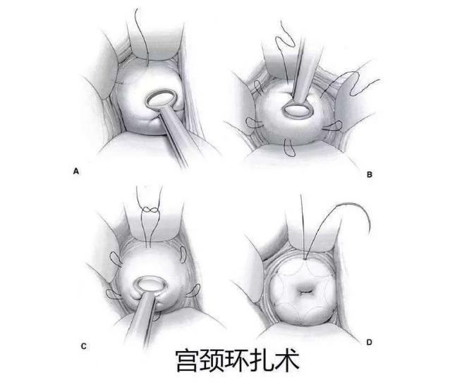 宫颈机能不全患者可以生二胎吗,宫颈机能不全破水流产