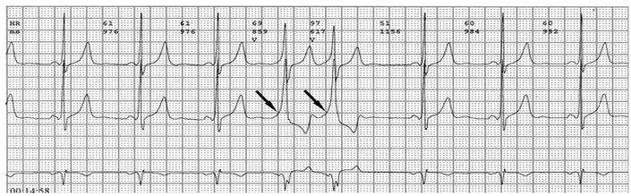 预激综合征是心脏的什么病,预激综合征什么引起的
