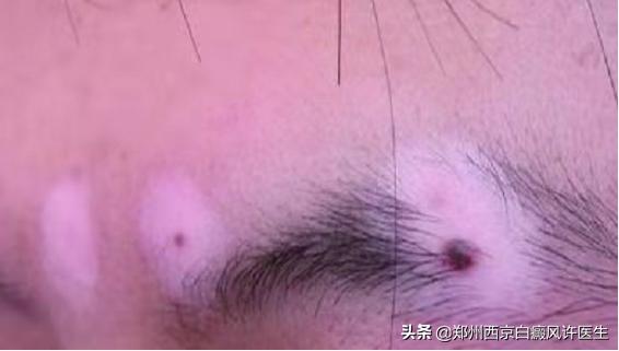 白癜风晕痣能彻底治好吗,晕痣白癜风好转的现象