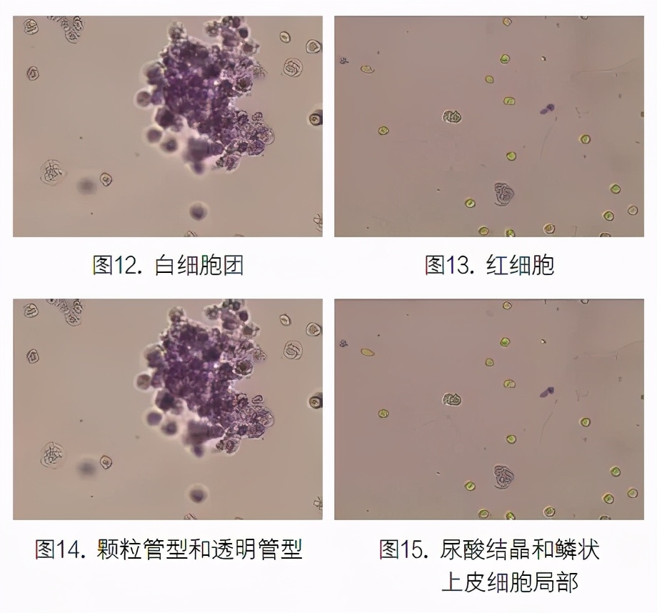 尿液有形成分分析的应用进展,尿液染色方法