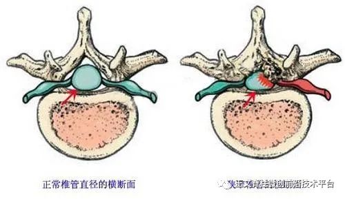 一文了解腰椎间盘突出症,腰椎管狭窄症的简要综述