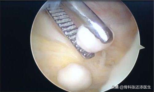 花椒治疗滑膜积液,艾叶生姜花椒敷膝关节积液管用吗