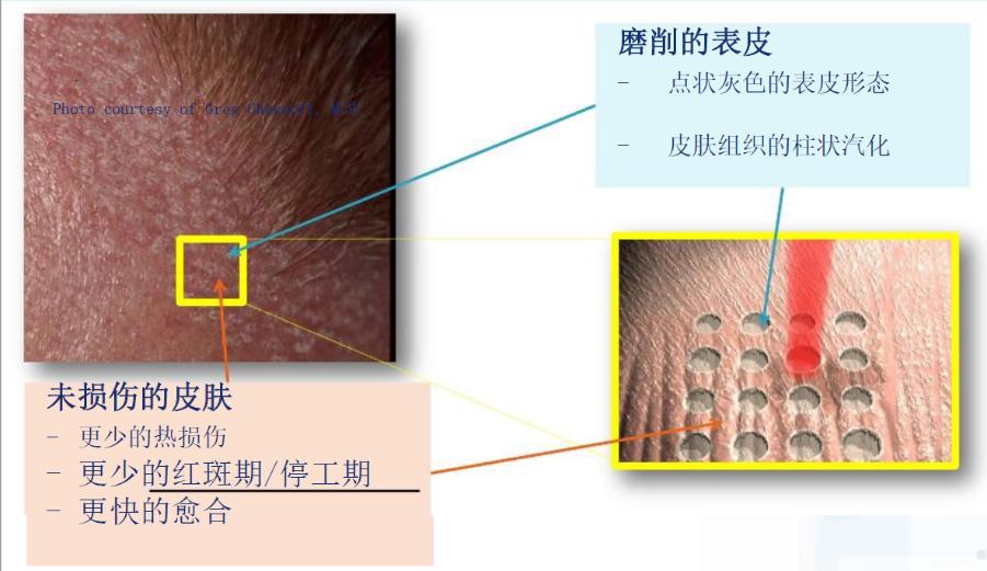超脉冲co2点阵激光可以祛妊娠纹吗,脉冲点阵激光和co2点阵激光