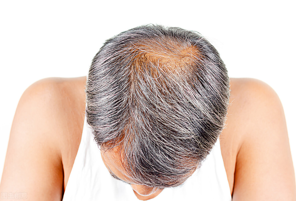 鬼剃头怎么治能长出新头发,鬼剃头脱发治疗最快的方法