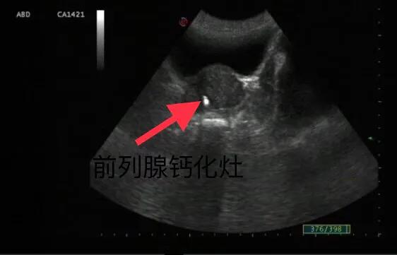前列腺钙化灶可以用冲击波治疗吗,前列腺钙化灶尿频尿痛怎么治疗