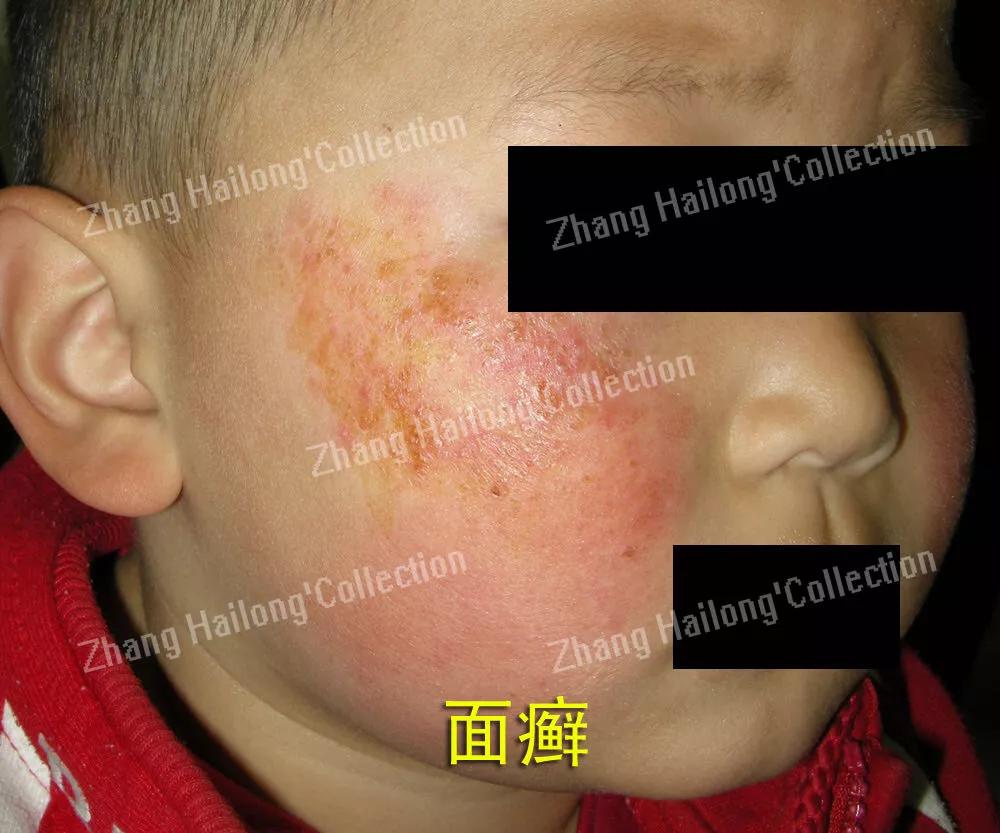 小狗脸上长癣怎么办,孩子脸上长癣是怎么回事啊