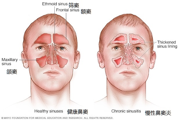 鼻窦炎的症状和鼻窦炎的治疗,全组鼻窦炎和全副鼻窦炎区别