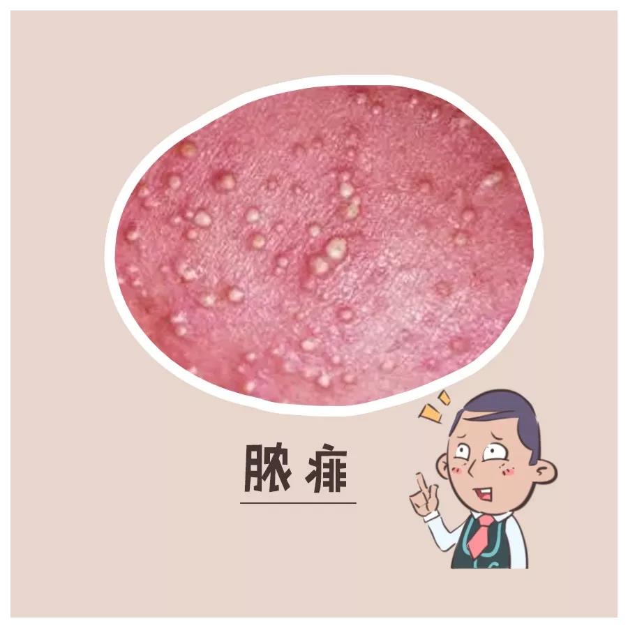 天气热怎么对付痱子,天热起痱子有什么好方法