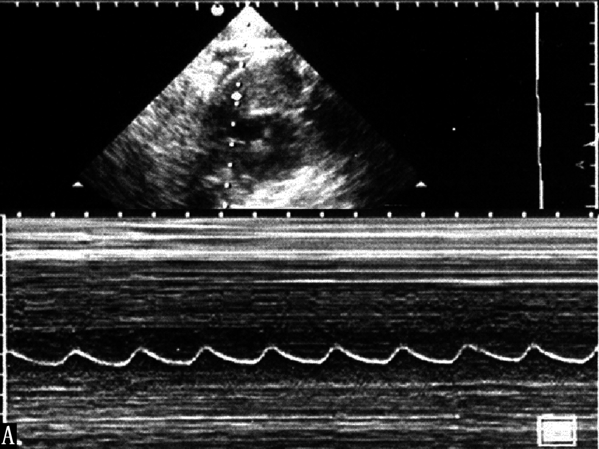 明明白白做超声（21）：胎儿发育生物物理学监测2-胎心活动及胎动