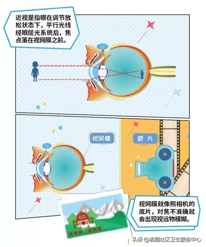 导致近视的措施,近视原因和预防方法