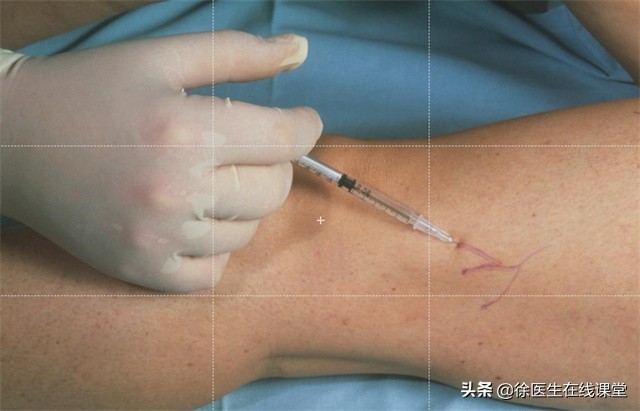 海绵状血管瘤遗传有没有方法检测,海绵状血管瘤会遗传给下一代吗