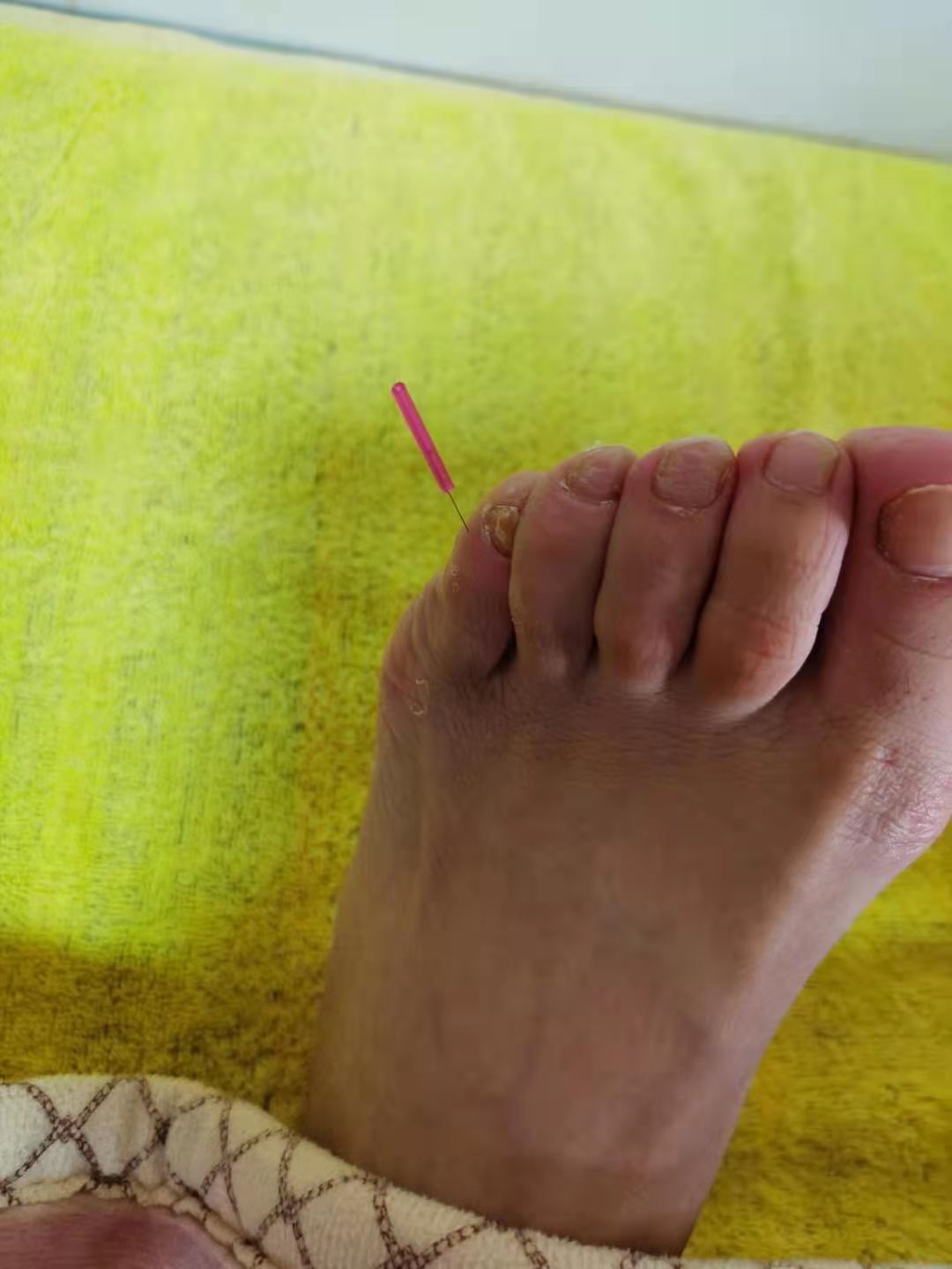 针灸治疗眩晕副作用,颈椎针灸能治疗眩晕吗