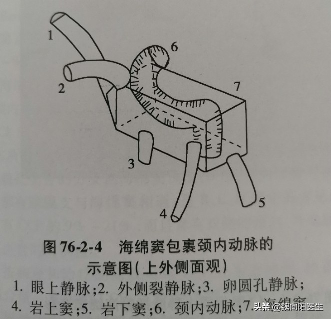 颈动脉海绵窦瘘症状,颈动脉海绵窦瘘介入需要多少钱