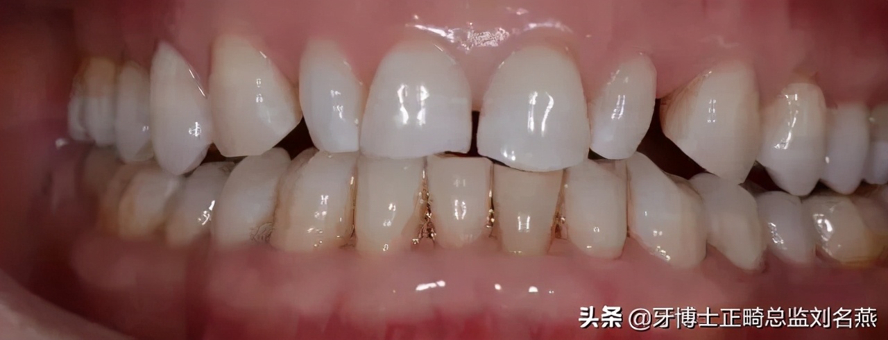 楔状缺损怎么修补,楔状缺损充填视频