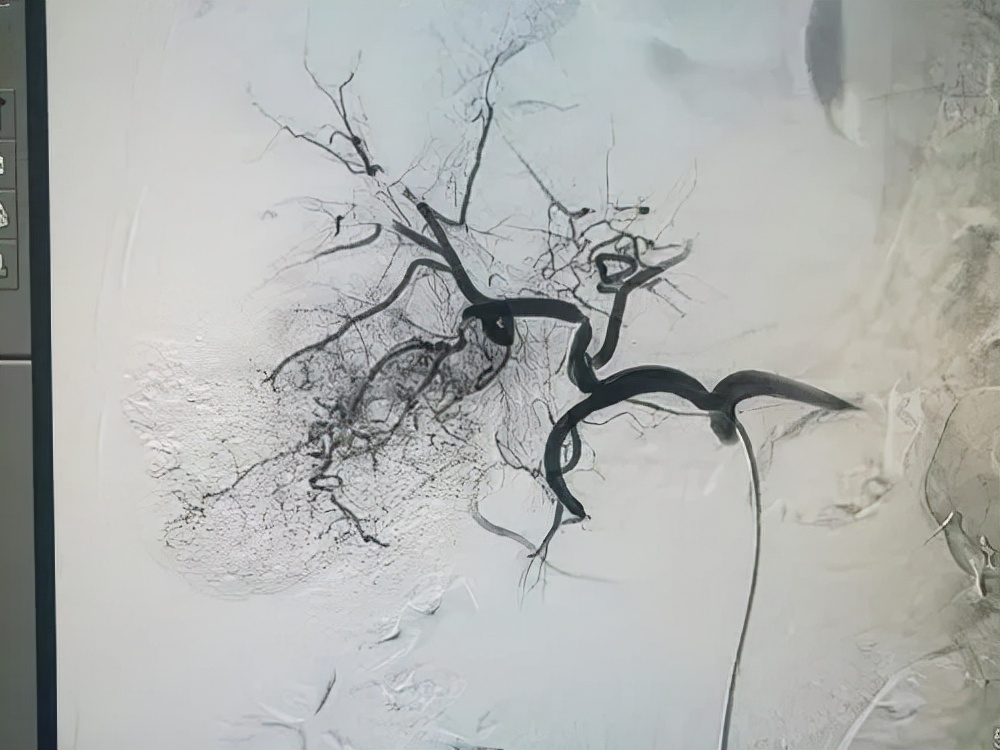 肝癌介入灌注化疗的并发症,肝癌介入治疗出现肝性脑病怎么办