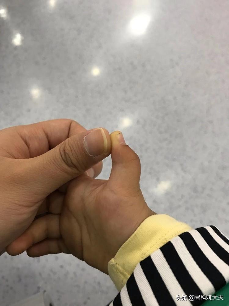 小孩大拇指伸不直的原因是什么,小孩子大拇指伸不直是什么原因