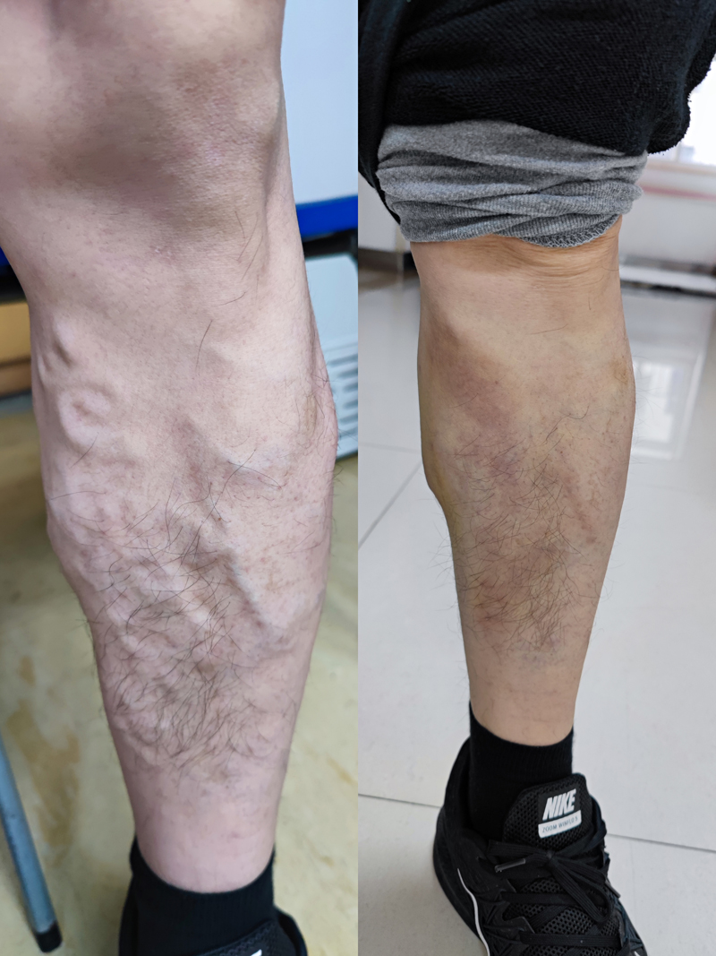 十堰市中医医院静脉曲张,中医针灸静脉曲张