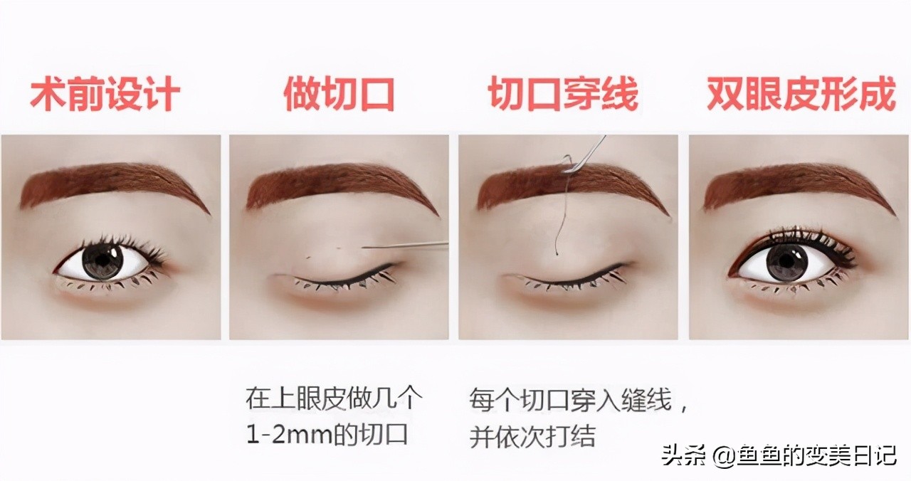 双眼皮知识点总结大全,关于双眼皮的十大真相