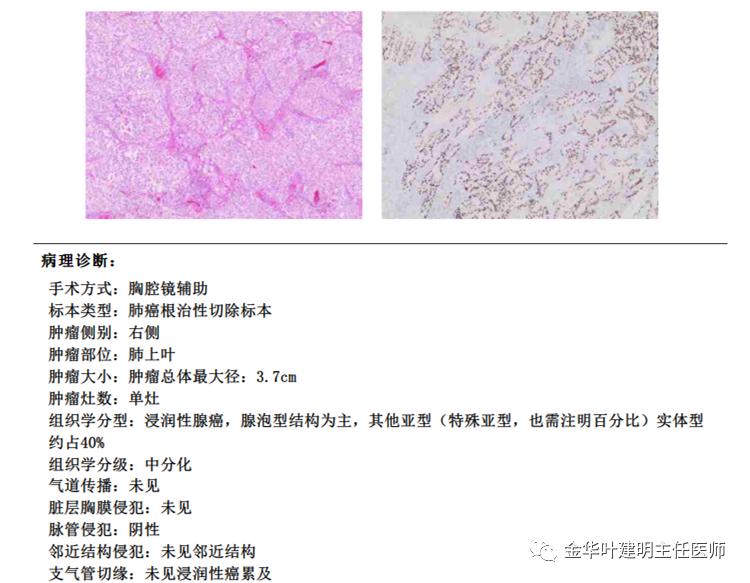 得了肺癌做肺部穿刺有影响吗,肺部穿刺可以确诊肺癌吗