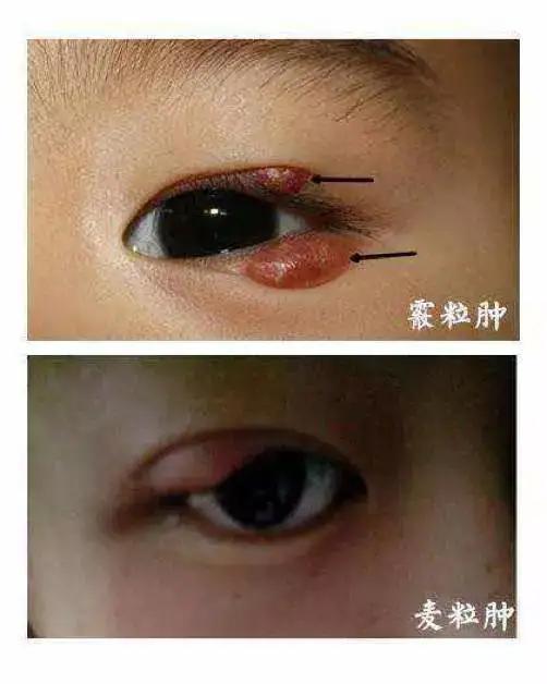 眼睛皮里面长了一个包,眼睛长包会导致视力变弱吗