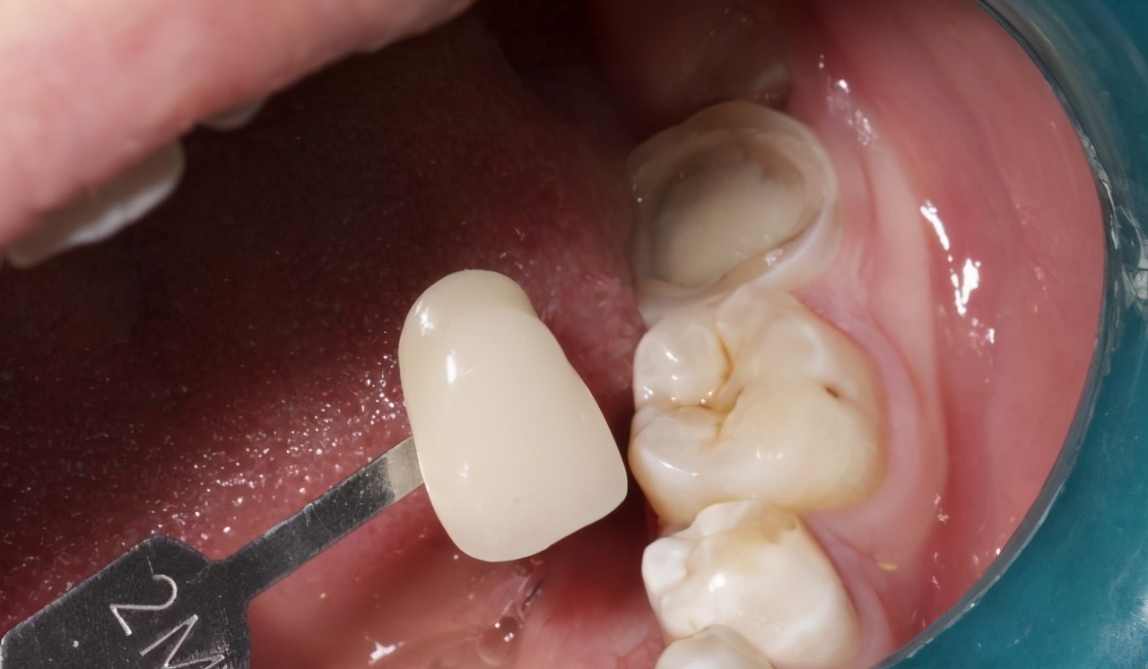 根管治疗后牙裂了还可以做牙冠吗,根管治疗后戴牙冠有什么利弊