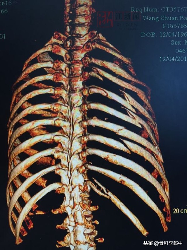 开胸手术断的肋骨怎么办,肋骨断了手术需要多少钱在上海