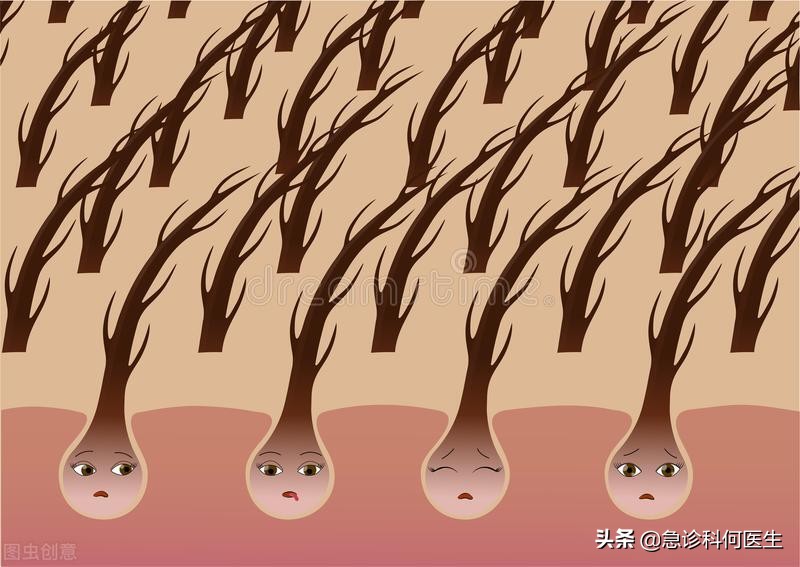 雄激素性脱发到底什么原因引起的,如何应对雄激素性脱发