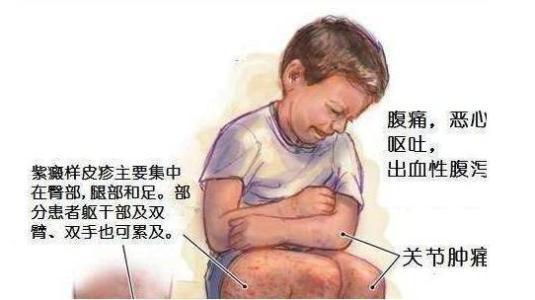 过敏性紫癜体质差会一直反复发作,过敏性紫癜看血液科专家可以吗