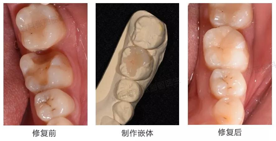 牙齿楔状缺损修复视频,牙齿缺损了可以选择哪些修复方式