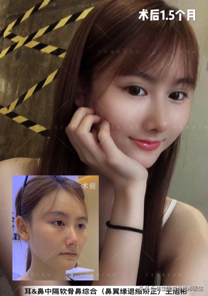 王旭彬：朝天鼻、露鼻孔，模特菲菲短鼻矫正手术后1.5个月
