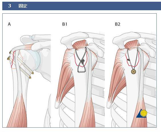 骨科知识速记口诀,如何系统的学习骨科