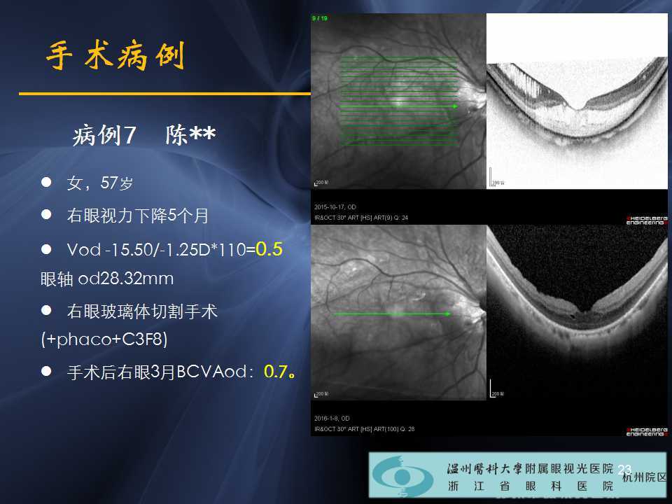 高度近视黄斑劈裂哪家医院好,高度近视黄斑劈裂中医治疗