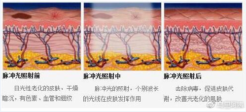光子嫩肤脱毛仪的危害和禁忌,光子嫩肤注意事项文字