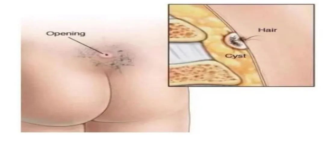 骶尾藏毛窦多毛的罪魁祸首,尾部藏毛窦治疗方法