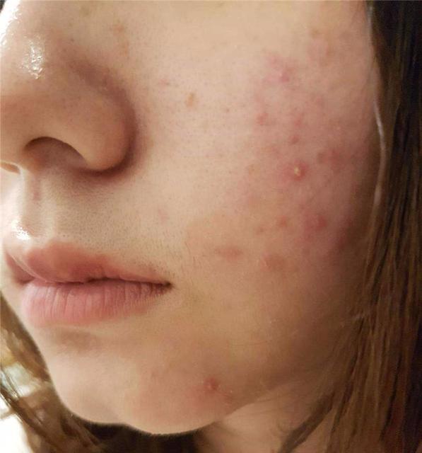 *疮痤**的治疗用药，请收藏