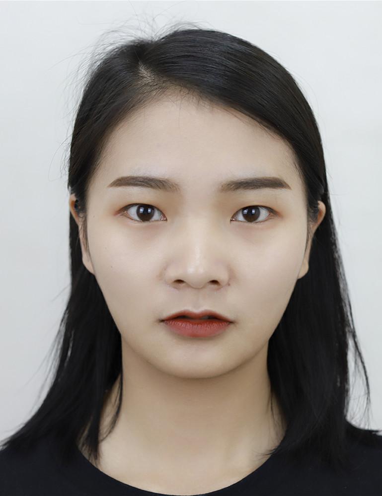 想了很久终于鼓起勇气去整容,埋线双眼皮10年想做个全切双眼皮