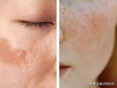 祛斑一个月了怎么还没有好,最可靠也最有效的祛斑方法