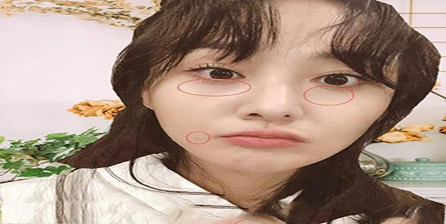 郑爽深夜营业痘痘暴起？医生提示：赶紧辨证论治+补美容觉