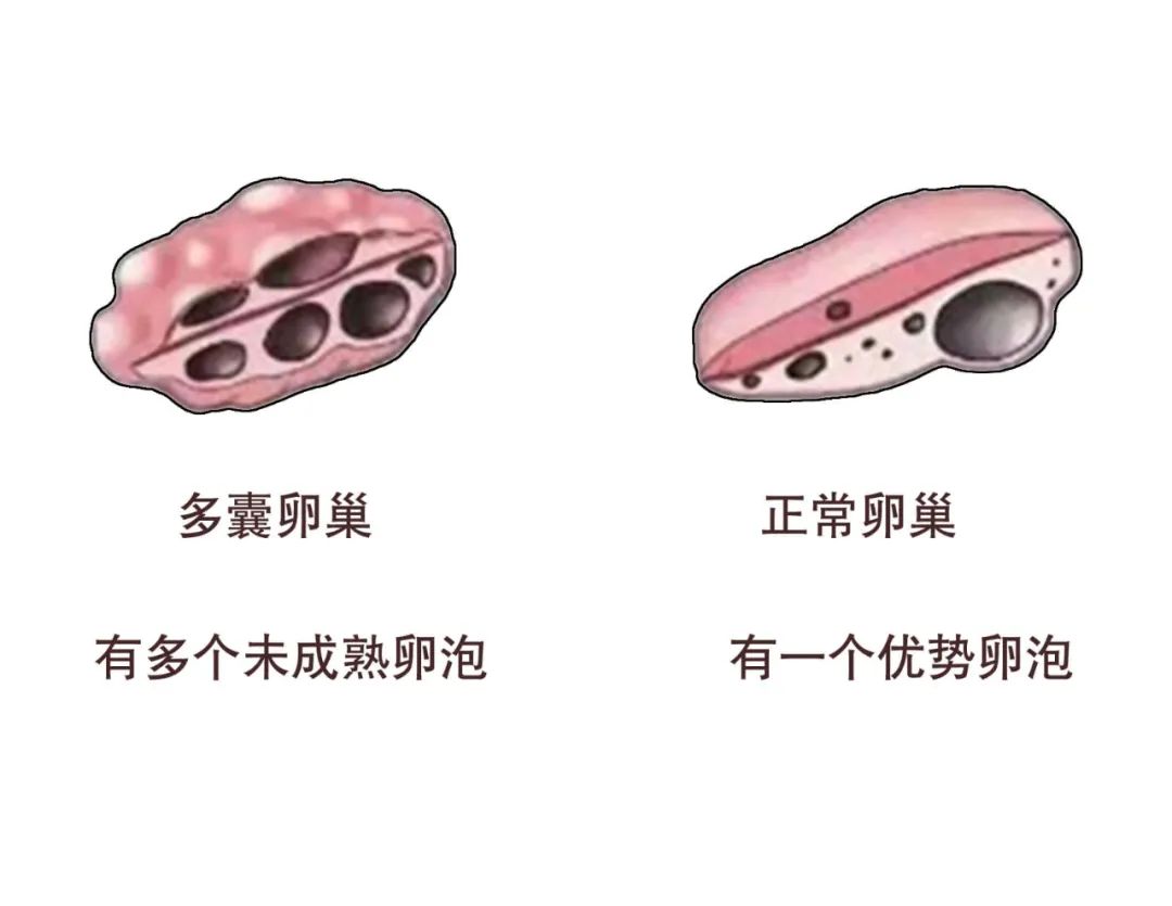 多囊多毛长痘怎么消除,多囊卵巢肥胖皮肤差怎么办